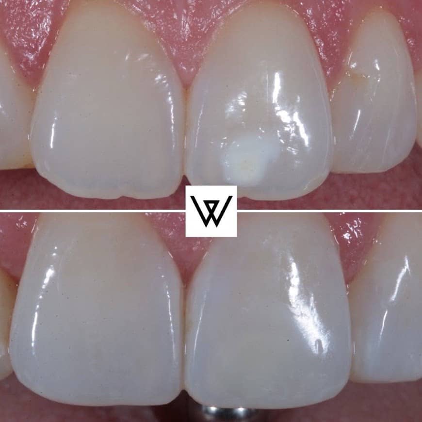 Before and after photo of teeth with composite bonding treatment