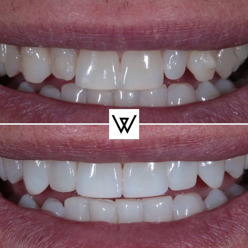 Before and after photo of teeth with composite bonding treatment