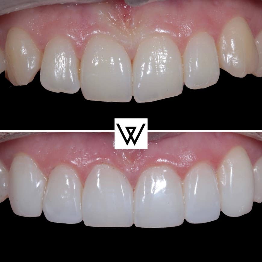 Before and after photo of teeth with composite bonding treatment