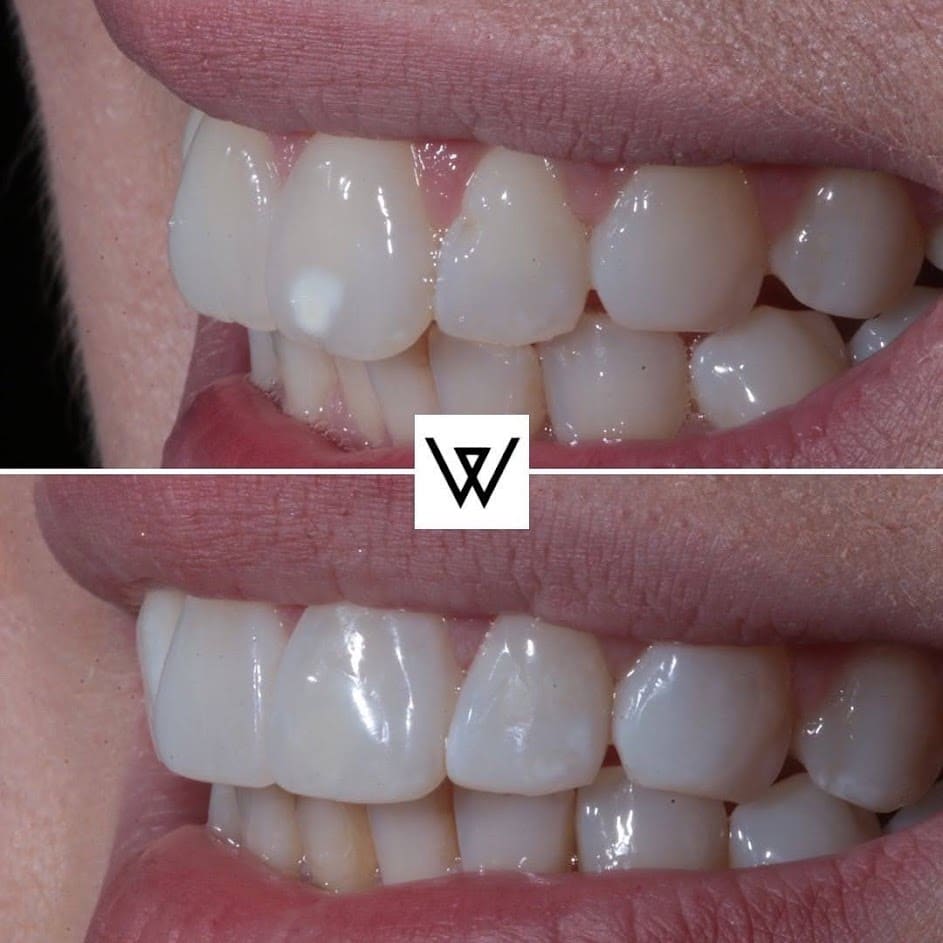 Before and after photo of teeth with composite bonding treatment