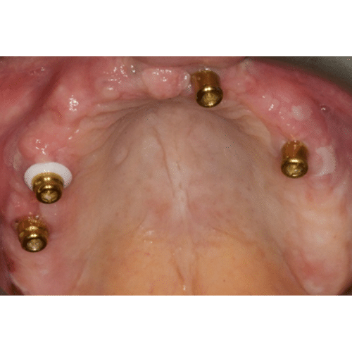 Close-up inside a mouth, looking up at toothless gums with abutments in place