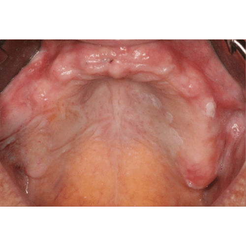 Close-up inside a mouth, looking up at toothless gums