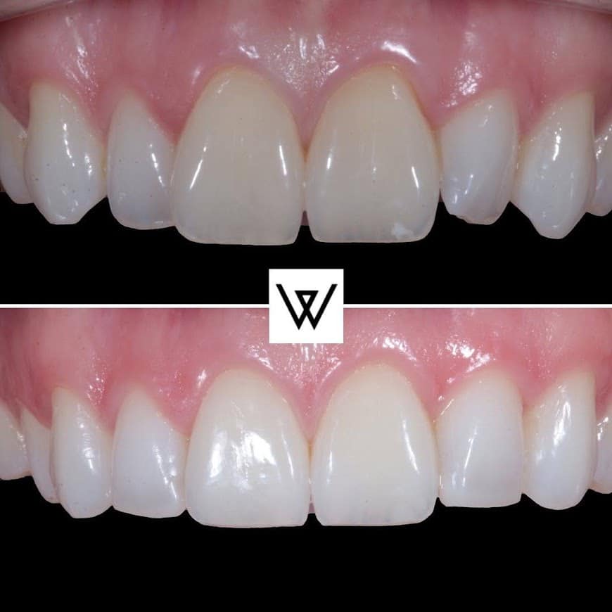 Before and after photo of teeth with composite bonding treatment