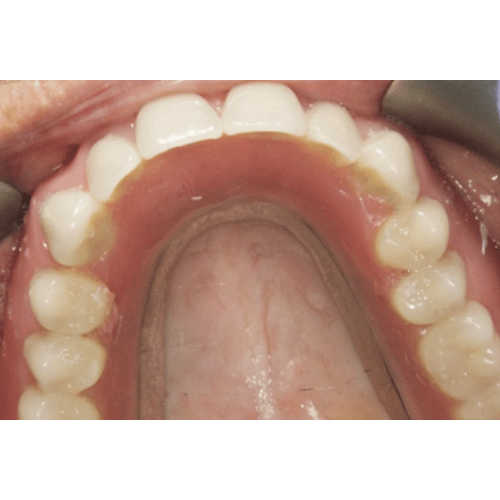 photo looking down at a set of upper dental implants that have been screwed in place.