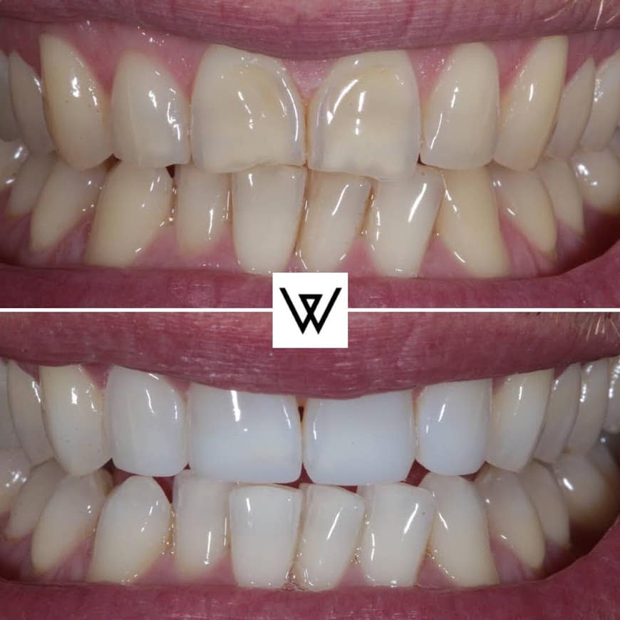 Before and after photo of teeth with composite bonding treatment
