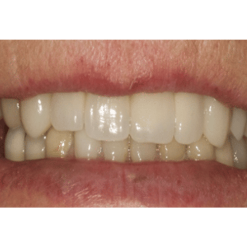 close-up photo of teeth after dental implant treatment