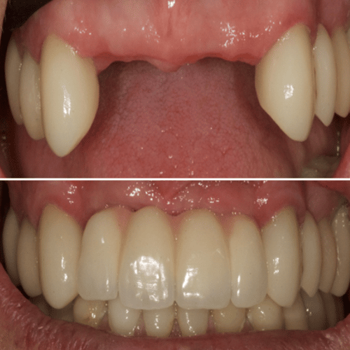 Before and after photo of teeth with dental implants treatment
