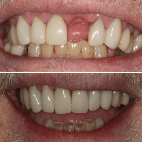 Before and After Photo of Dental Implants Rotherham