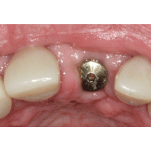 Close up photo of a dental implant abutment - Rotherham
