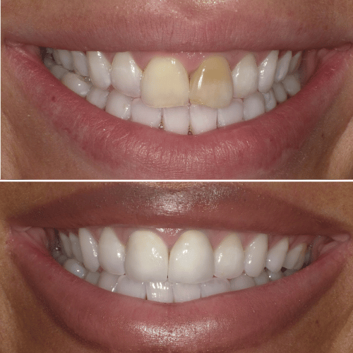 Before and after photo of crowned teeth treatment.