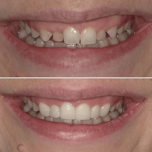 Before and after photo of crowned teeth treatment.