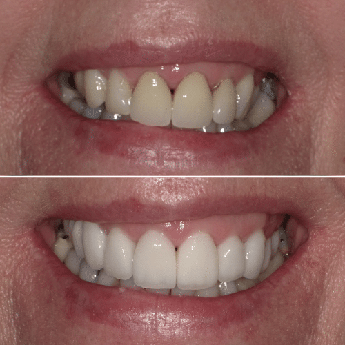 Before and after photo of crowned teeth treatment.